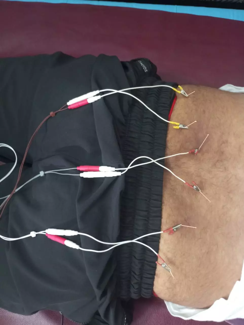 srinidhi physiotherapy and acupunture sarpavaram in kakinada - Photo No.8