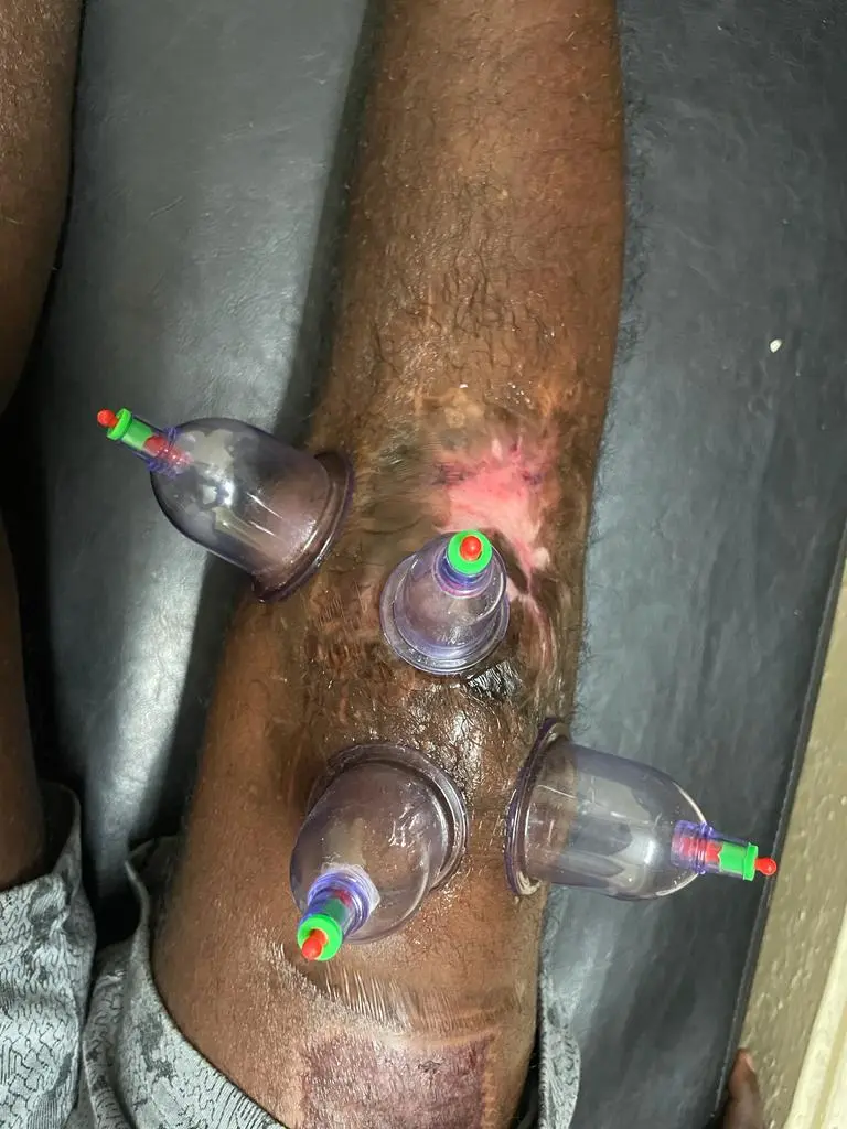 Srinidhi Physiotherapy And Acupunture Sarpavaram In Kakinada - Photo No. 11